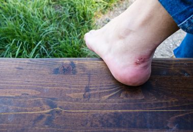 First aid for preppers, blisters, burn, and wounds